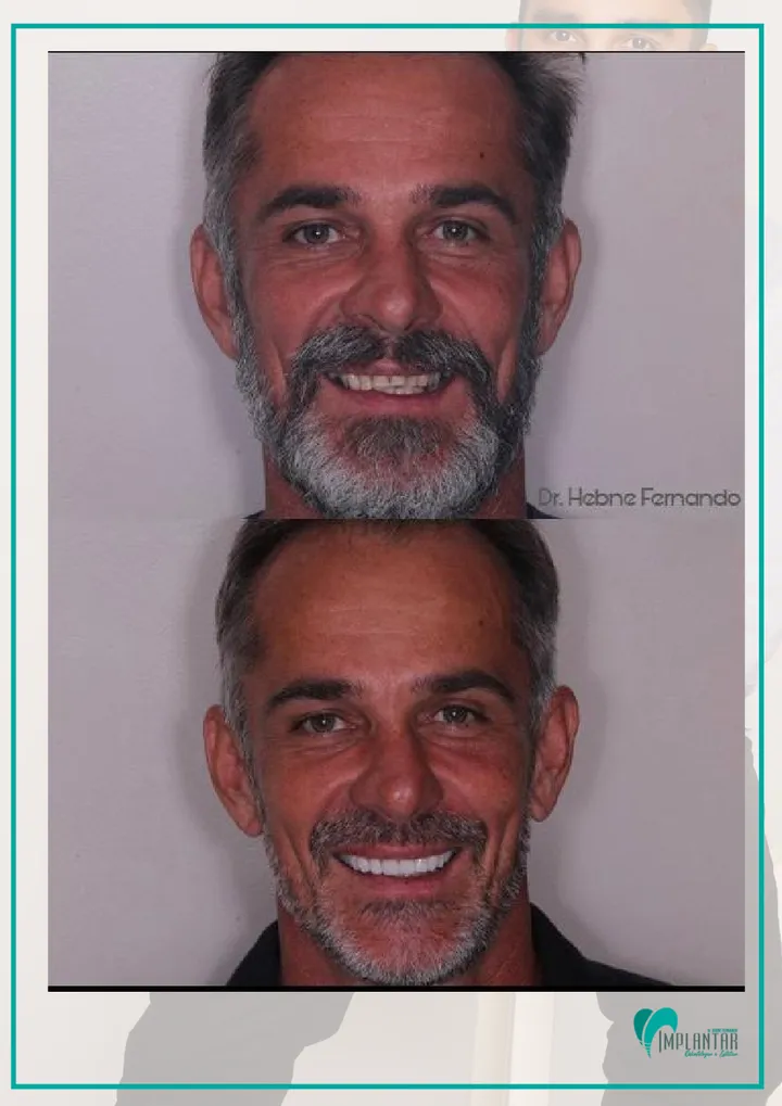 Antes e depois de reabilitação do sorriso