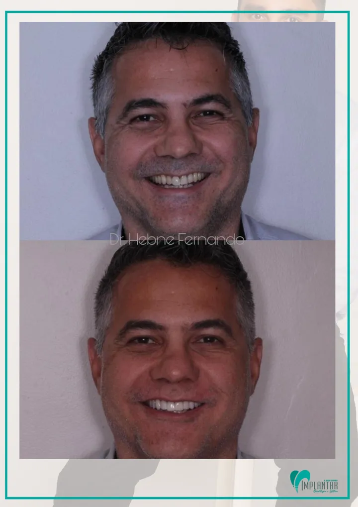 Antes e depois de lentes dentais